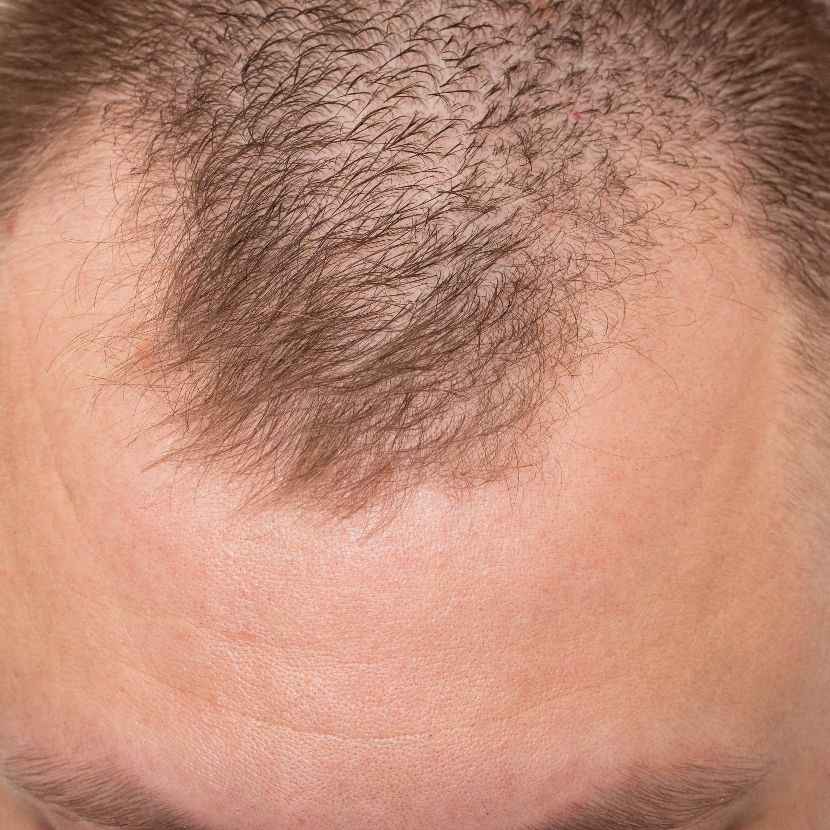 Non-scarring alopecia