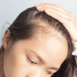Causes of Hair Loss - Alopecia