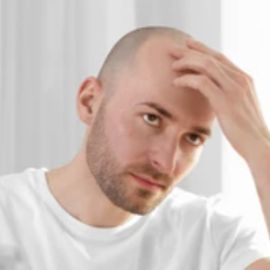 Causes of Hair Loss - Baldness