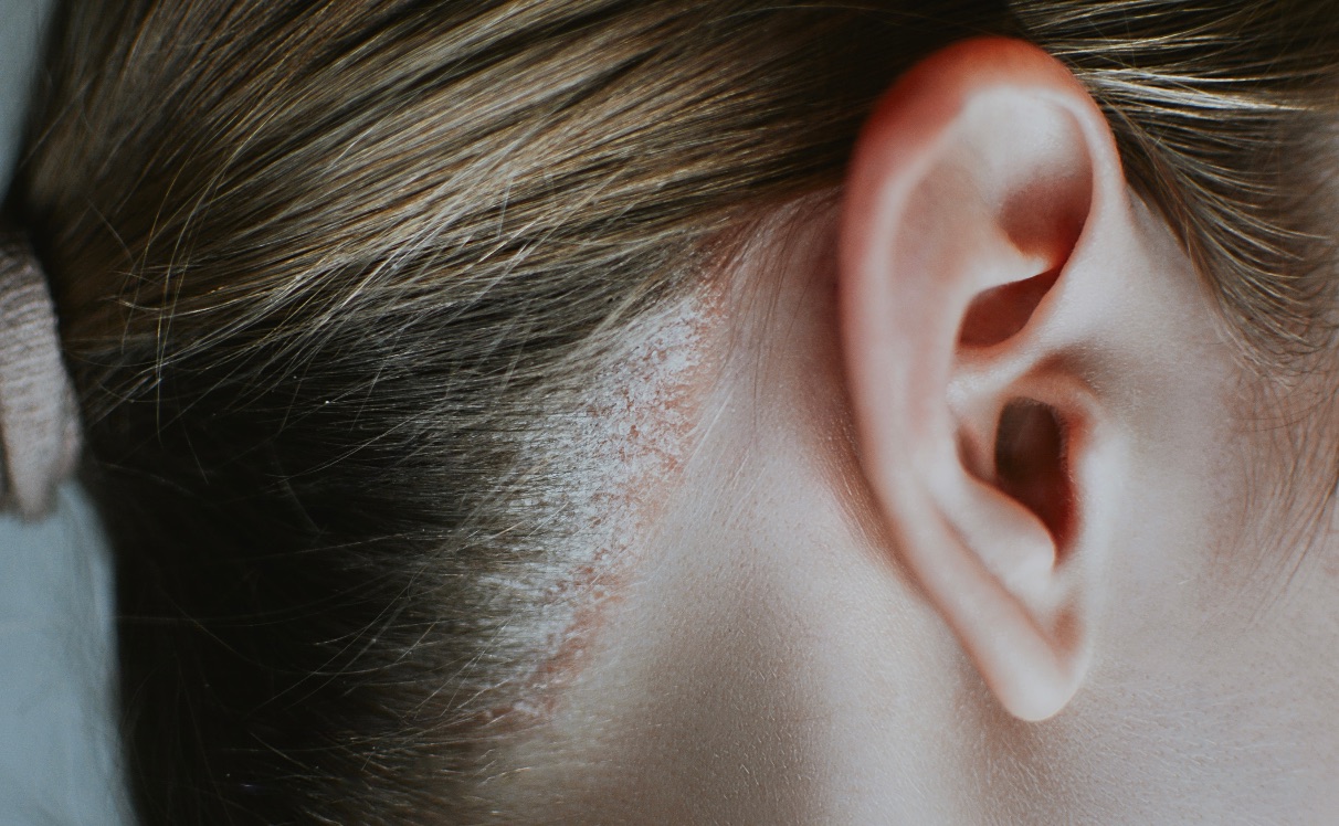 Seborrhoeic Dermatitis – A Scalp Condition