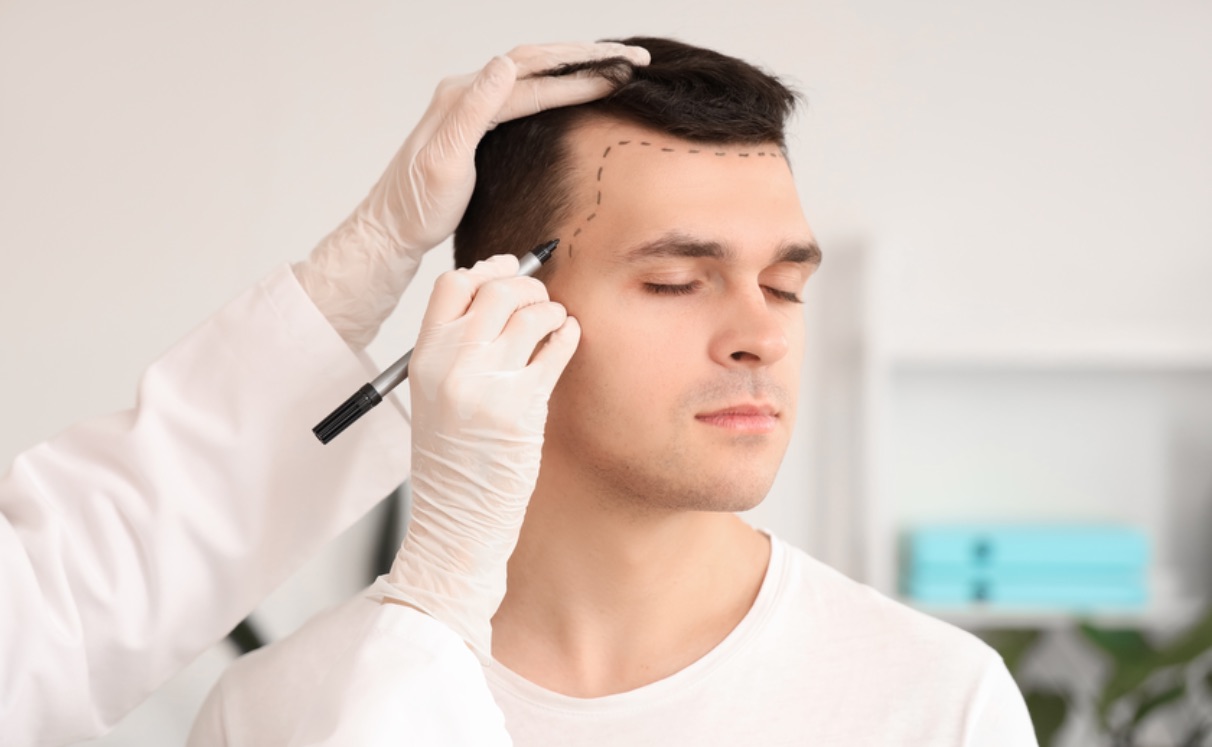 Myths and Truths About Hair Transplants: What You Need to Know