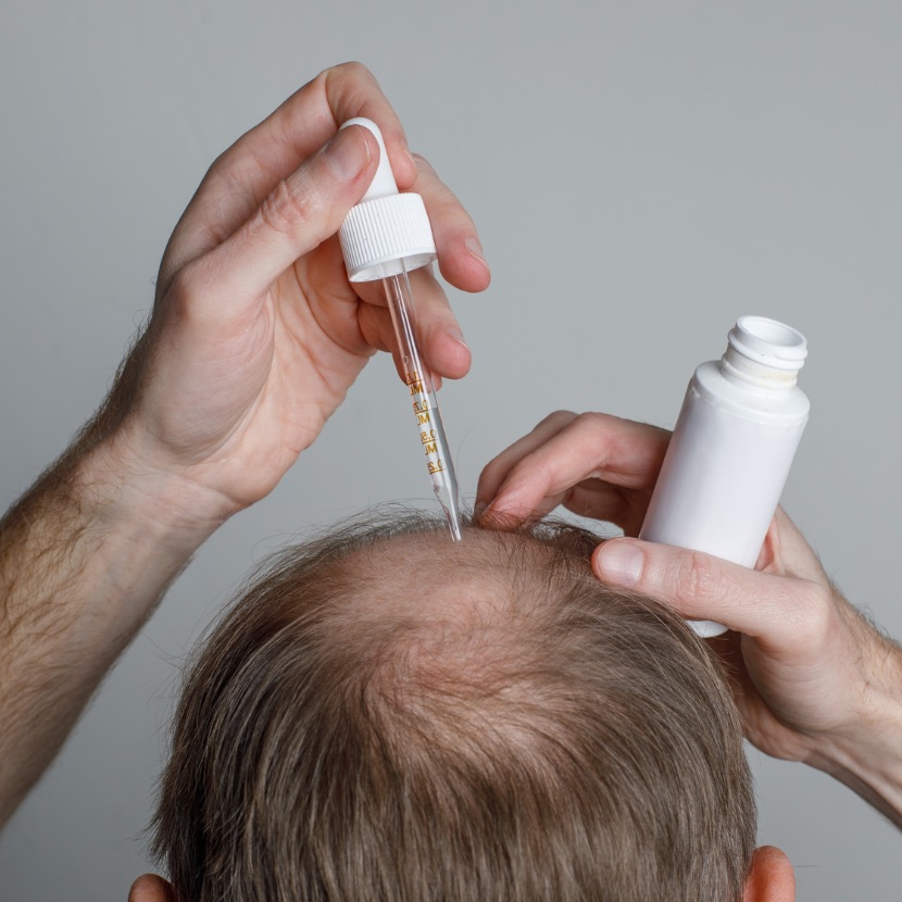 Is Minoxidil effective in very advanced stages of baldness?