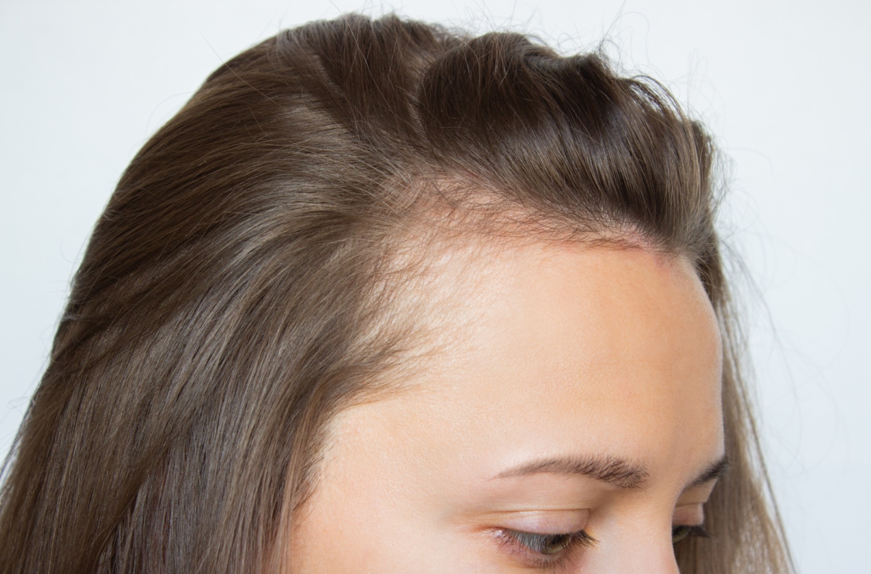 Advantages of a Female Hair Transplant