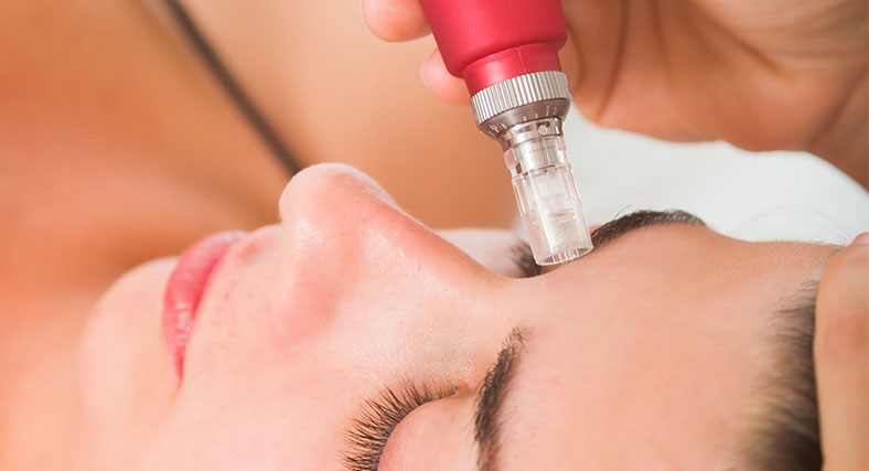 Microneedling Capilar